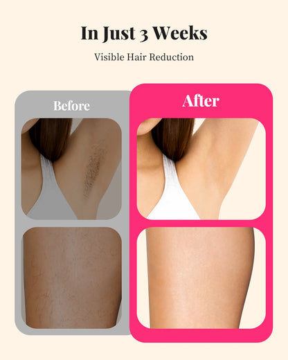 Professional IPL Hair Removal Device